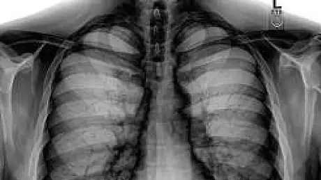 Adevarul despre radiografii. Ce se intampla, de fapt, cand razele X intra in organismul nostru