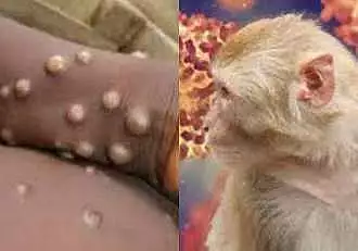 Au fost confirmate alte doua cazuri noi de variola maimutei. Ambele persoane infectate sunt din Bucuresti