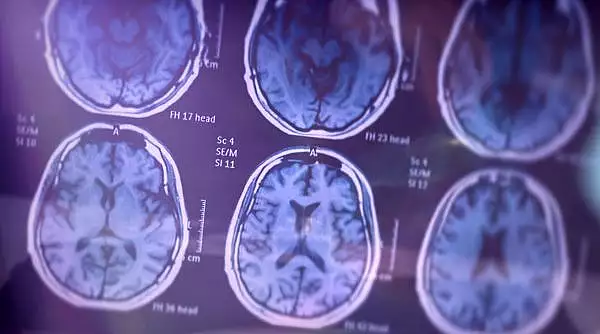 Boala Alzheimer ar putea fi diagnosticata din timp prin analize de sange. Ultimele descoperiri ale cercetatorilor japonezi