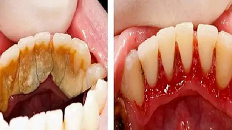 Cum scapi de tartru cu 3 alimente banale. Dentistii ti-au ascuns mereu asta!