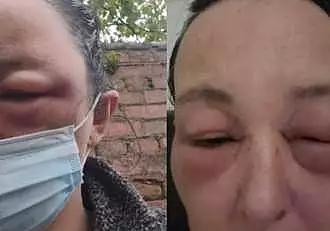 O femeie de 41 de ani a trait socul vietii sale, dupa ce a avut o reactie alergica la vopseaua de par. Cum arata acum: "Nici macar propriul meu tata nu m-a putu