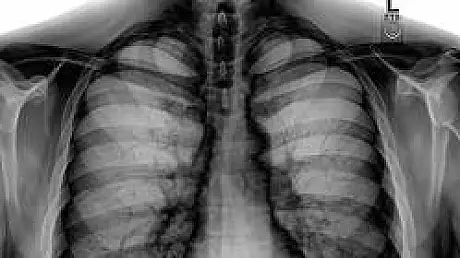 Radiografie ULUITOARE! Medicii au ramas FARA CUVINTE dupa ce au vazut asta