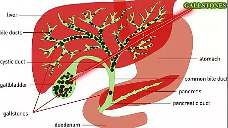 Simptome care arata ca ai probleme cu ficatul. Vezi daca si tu esti in pericol