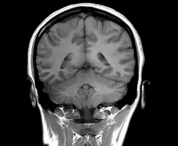 STUDIU: Supravietuitorii Covid pierd substanta cenusie din creier. Care sunt efectele