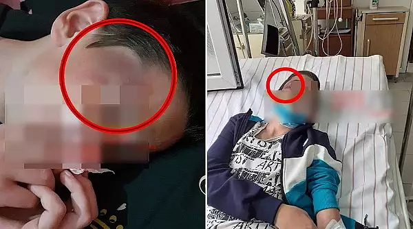 Un copil batut de tatal vitreg a fost machiat de mama lui ca ranile sa para mai grave