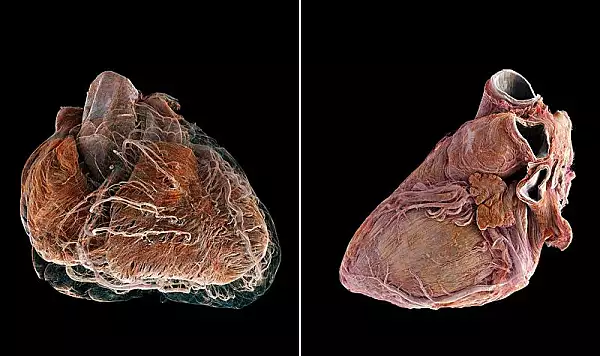 Un VIDEO uimitor arata diferenta dintre o inima sanatoasa si una afectata de boli cardiovasculare